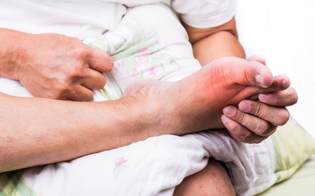 Wat voor invloed heeft voeding op jicht?